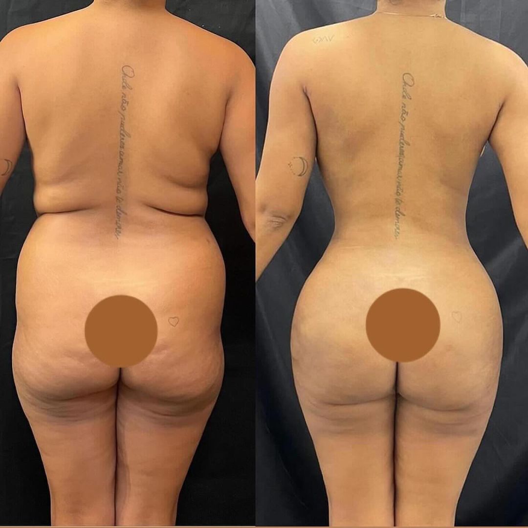 Thalyta Alves mostrou o antes e depois de sua lipoaspiração Reprodução/Instagram