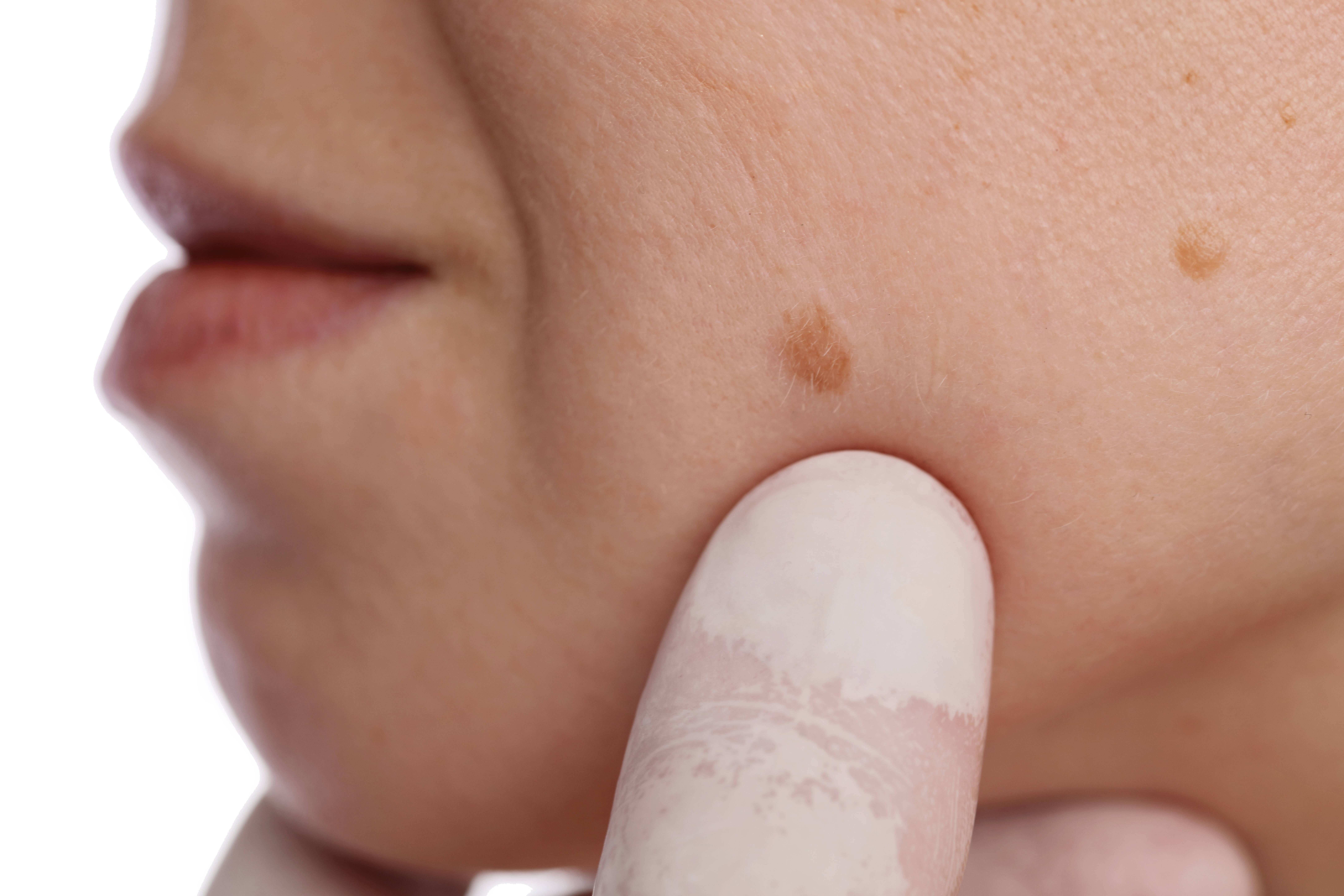 Manchas e pintas não devem ser ignoradas; consulte um dermatologista para um exame completo ao menos uma vez no ano. Foto: shutterstock/Reprodução