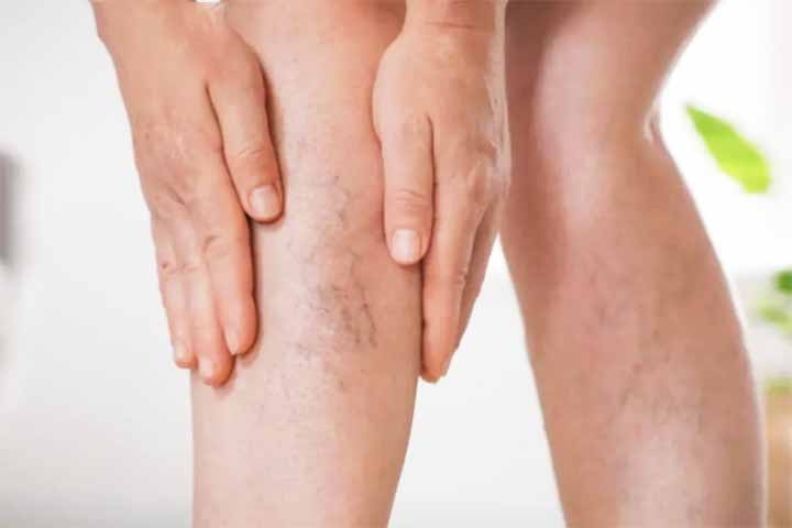 Isso acontece porque as válvulas venosas, pequenas estruturas que funcionam como “portas unidirecionais” para o fluxo sanguíneo, ficam danificadas ou enfraquecidas.
 Reprodução: Flipar