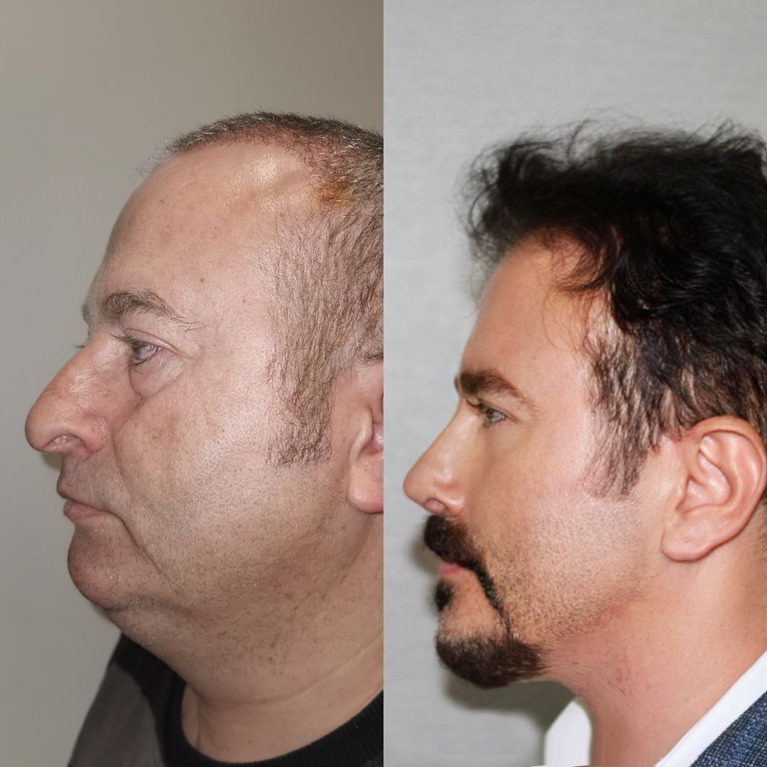 Fotos de perfil após cirurgias Reprodução: Instragram