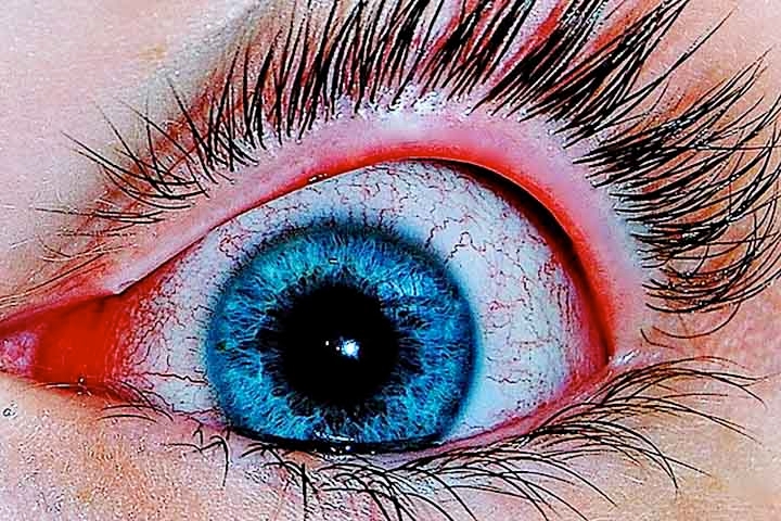 Os sintomas incluem vermelhidão, coceira, inchaço das pálpebras e sensação de corpo estranho nos olhos. O tratamento varia conforme a causa da inflamação e pode incluir colírios antibióticos ou anti-inflamatórios. Reprodução: Flipar
