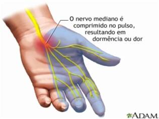 Formigamento para nos e dormência dedos icd 9
